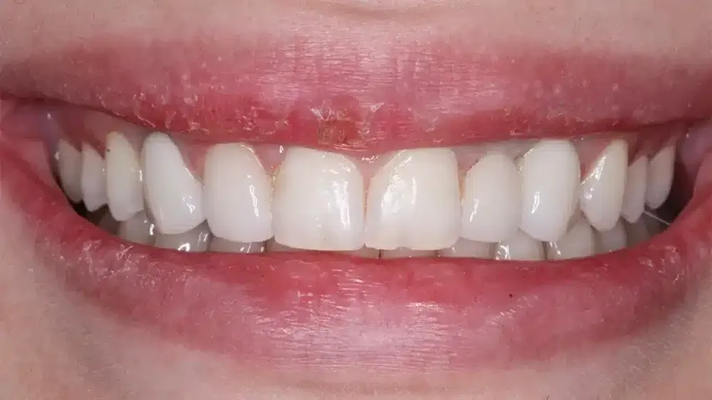 before after smile makeover 11