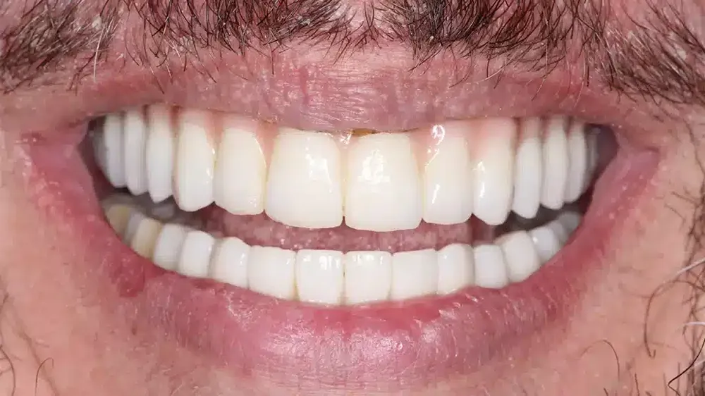 before after smile makeover 12