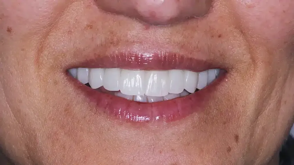 before after smile makeover 2