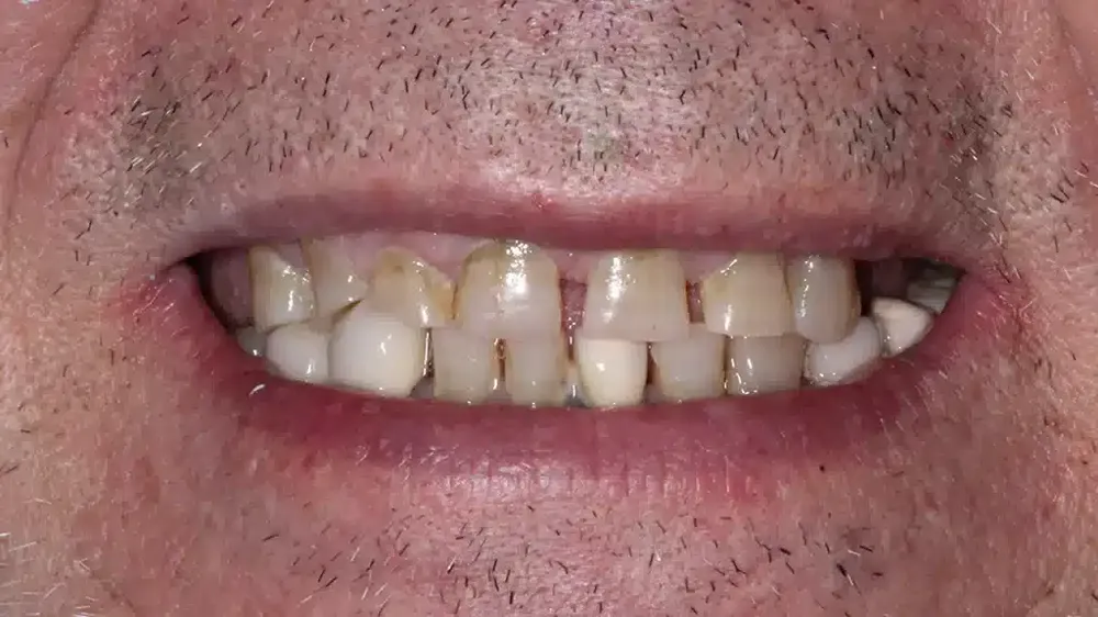 before after smile makeover 3