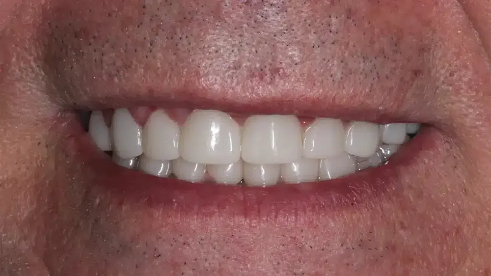 before after smile makeover 4
