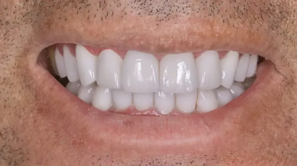 before after smile makeover 9