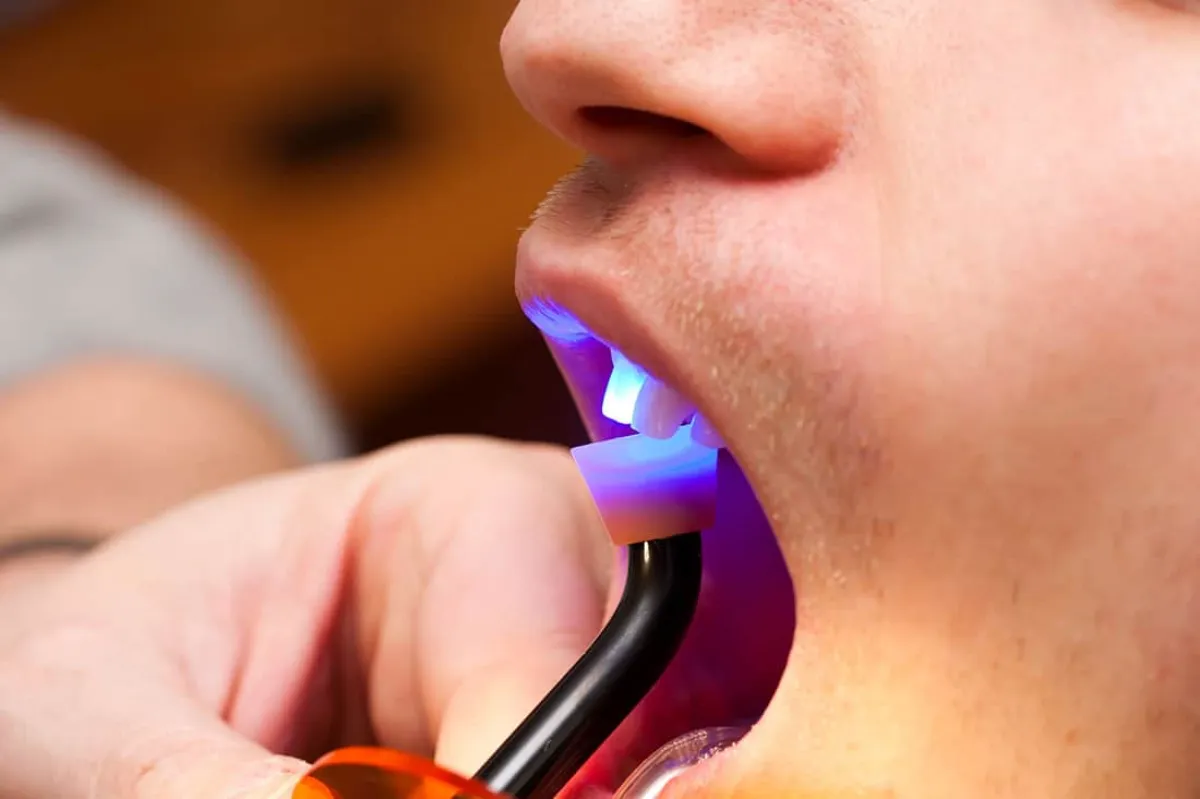 Dental Bonding