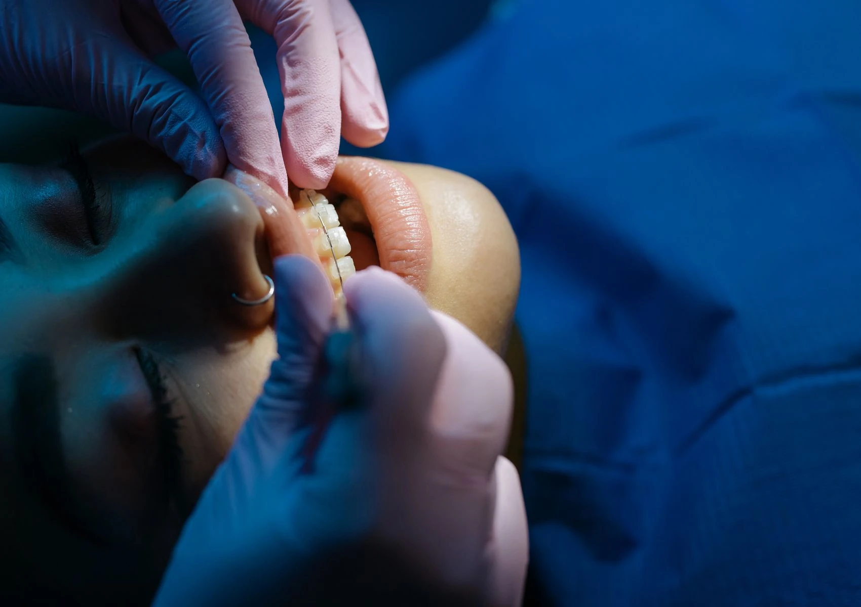 Types of Braces In Rancho Cucamonga