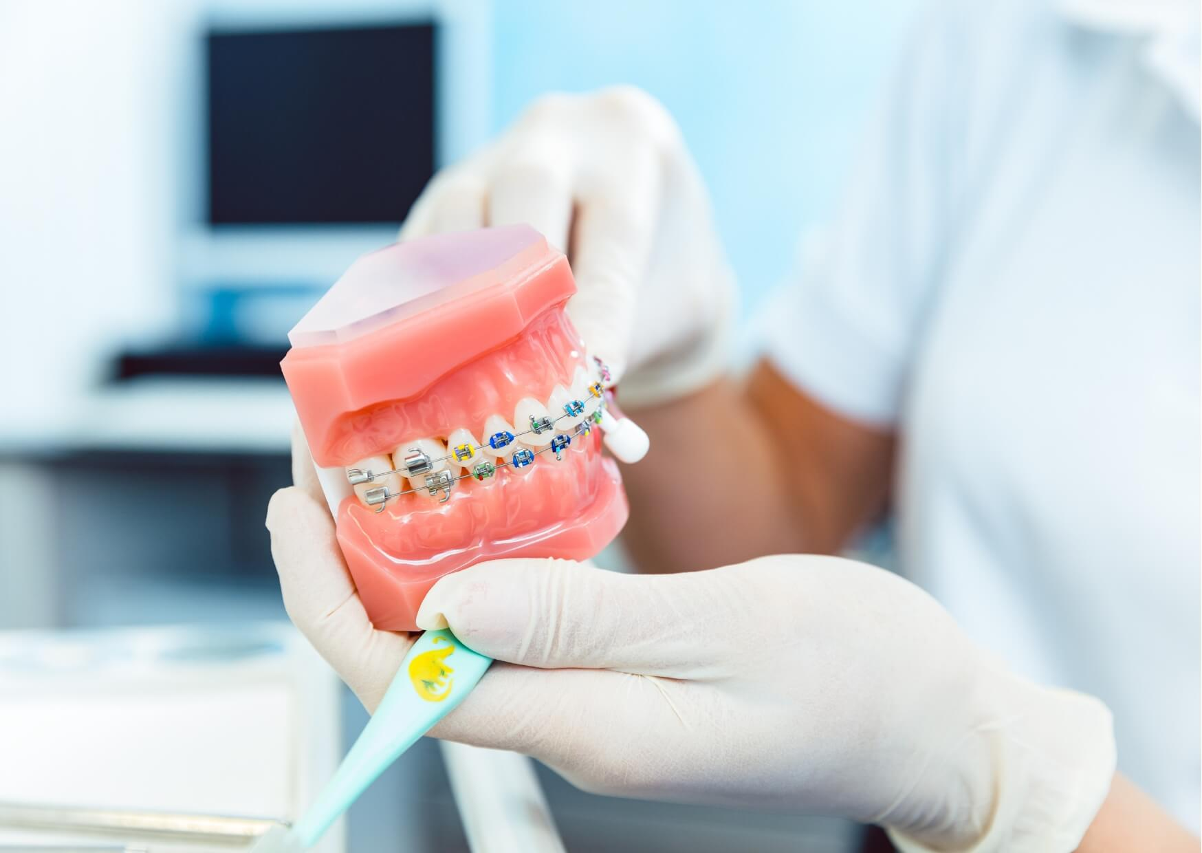 Dental model with traditional braces used to explain the differences between braces and Invisalign for teenage orthodontic treatment.
