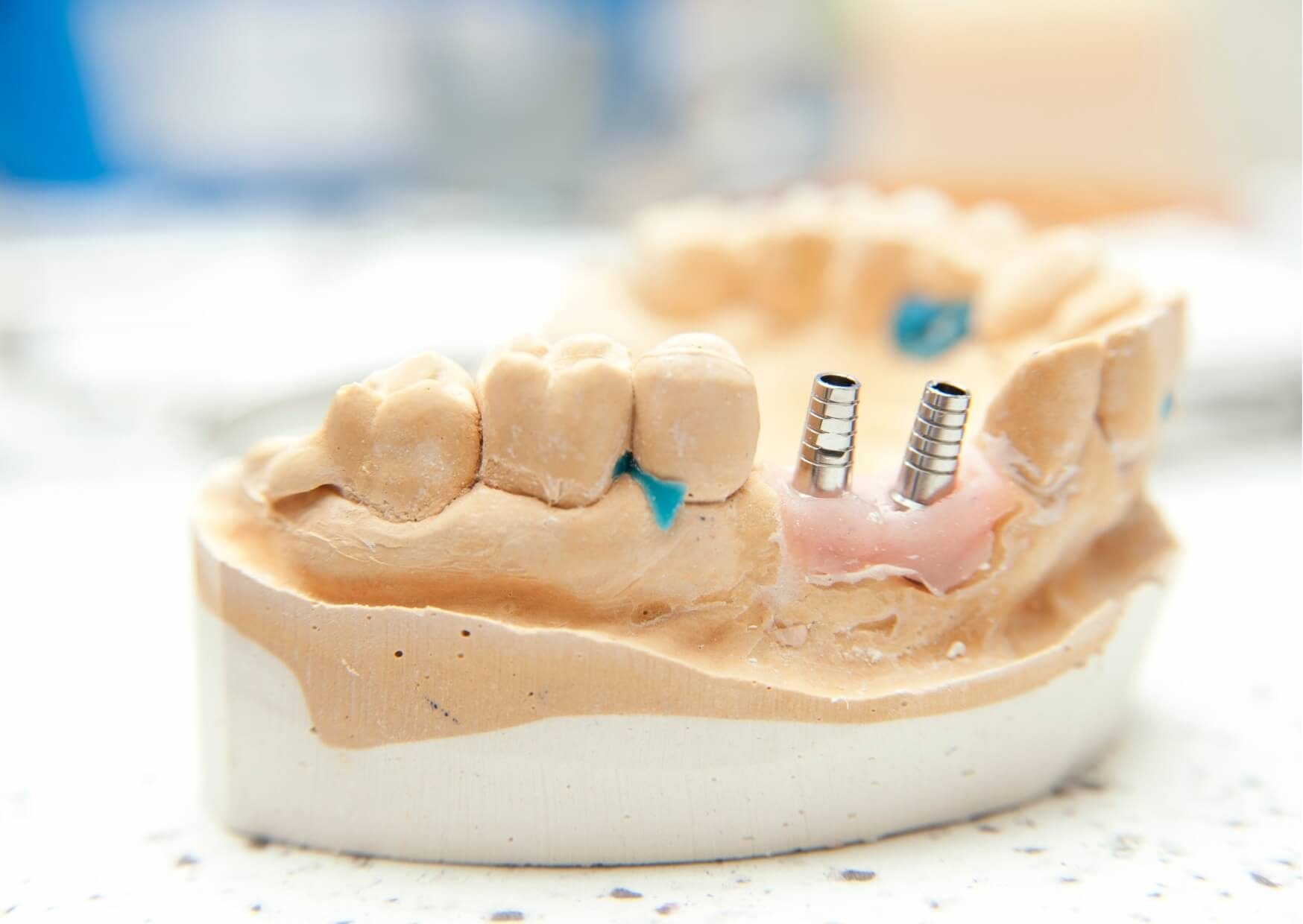 Dental implant model showing implant posts and surrounding teeth to illustrate the long-term stability and longevity of dental implants.